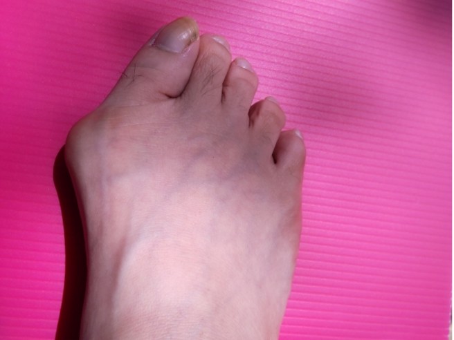 外反母趾イメージ1